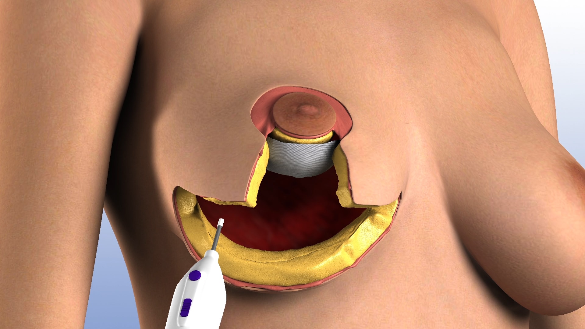 Highlight - Surgery Simulation